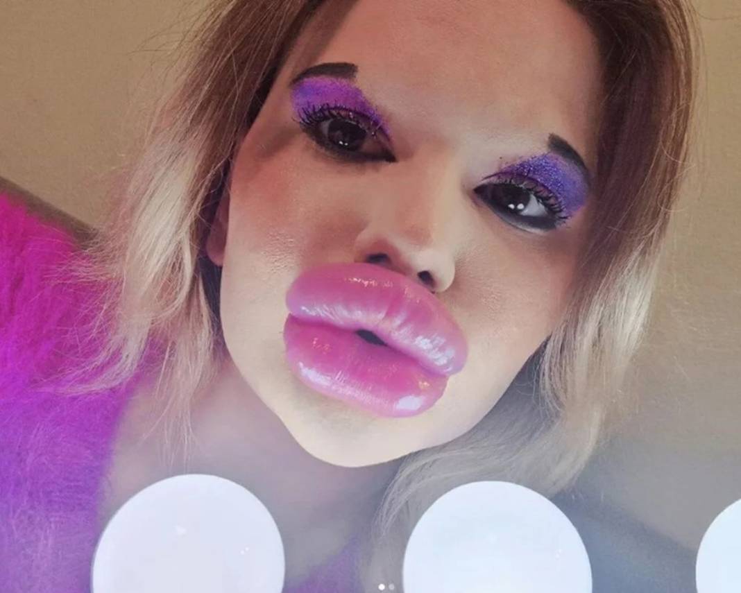 Dudak estetiğine harcadığı para 'dudak' uçuklattı 9